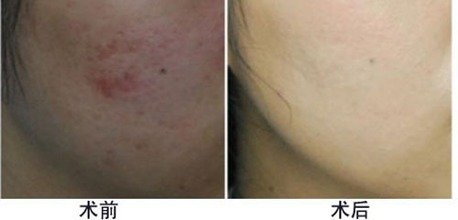 上海疤痕修复的价格多少