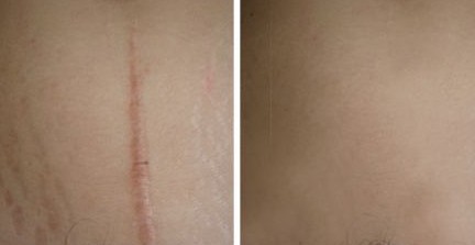 手术疤痕修复怎么做