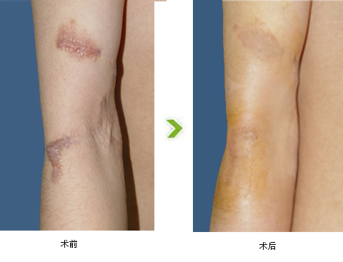 疤痕产生需要哪些护理