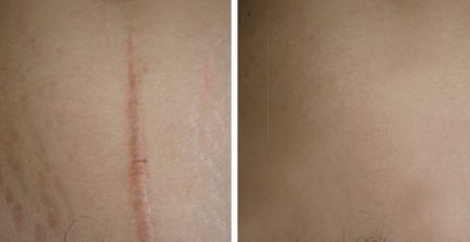 如何做好疤痕的护理工作