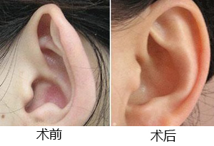 耳朵畸形如何矫正