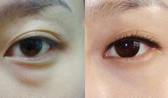 做眼部吸脂好不好