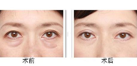 眼部吸脂后该注意哪些