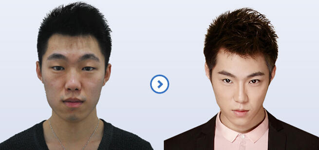 眼部吸脂注意事项有哪些