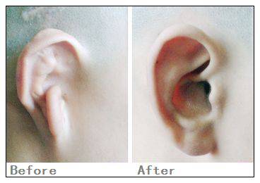 耳再造手术怎么做