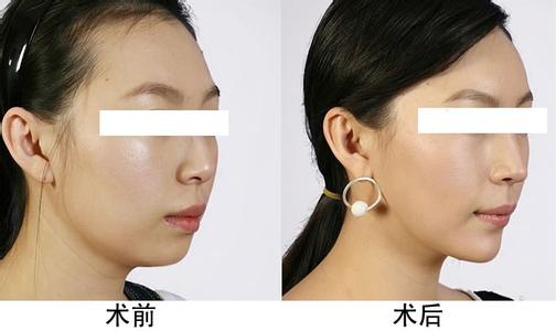 上海艺星下巴整形