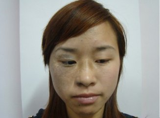 上海艺星激光祛太田痣好吗