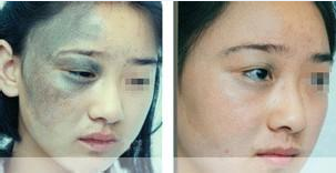 激光祛太田痣的价格贵吗