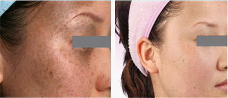 太田痣怎么去掉比较好