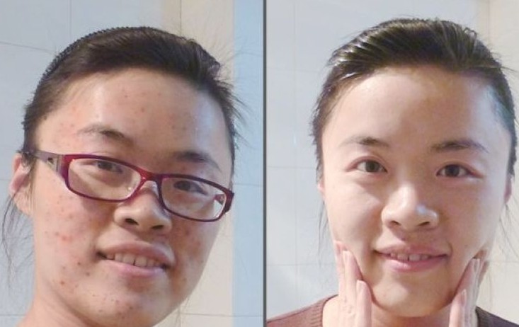 上海艺星激光祛痘印要多少钱