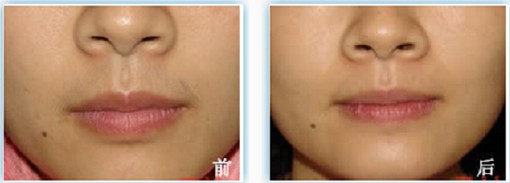 上海脱唇毛多少钱