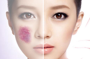 脸上的红胎记很大怎么办