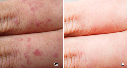 胎记能消除干净吗