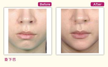 艺星下巴整形怎么样?