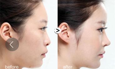 隆下巴手术是怎么做