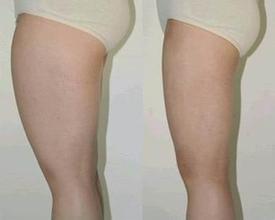 做大腿吸脂减肥后会留疤痕吗
