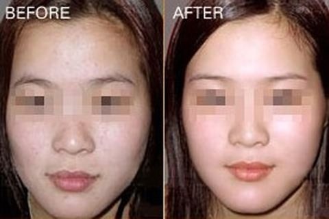 上海毛孔粗大该怎么护理