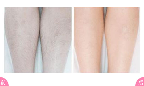 上海小腿脱毛多少钱