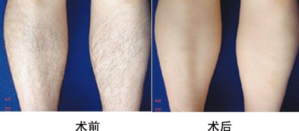 上海激光脱腿毛需要脱几次