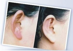 耳部畸形矫正的手术方法