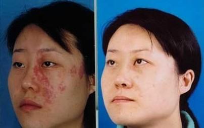 脸部有红色胎记怎么办好