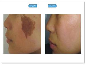 治疗红胎记需要多少钱