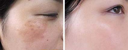 脸上的胎记好治吗