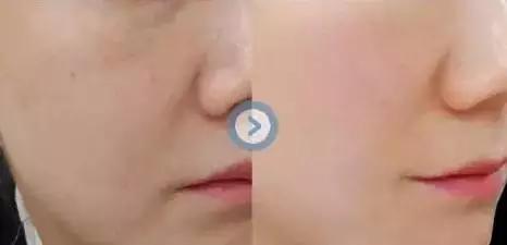 上海艺星水光的效果怎么样