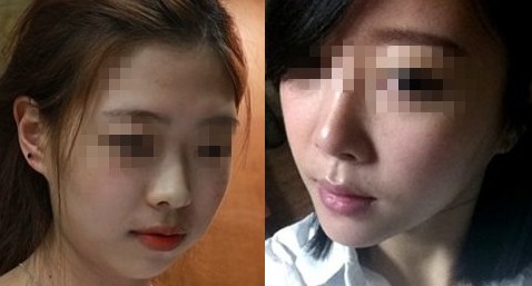 上海艺星面部吸脂