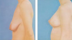 是需要乳房下垂