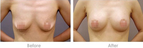 上海艺星乳房下垂矫正