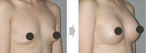 上海艺星乳房下垂