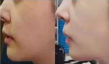 上海哪家医院打水光好