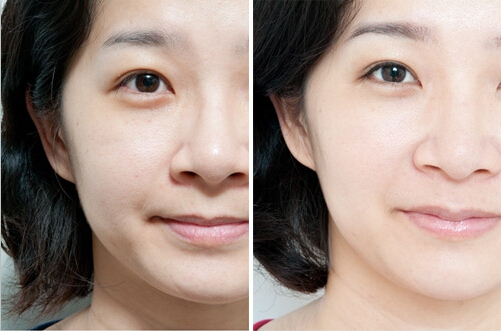 水光祛皱的优势有哪些