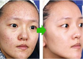 快速去痘印的方法有哪些