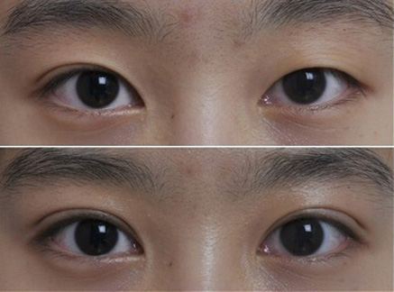 韩式埋线双眼皮的优点是什么