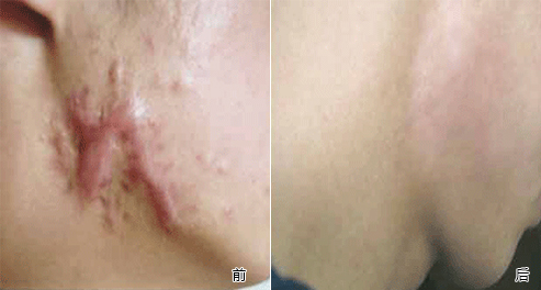 疤痕修复术后怎么护理