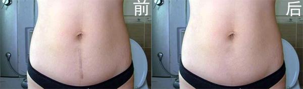 疤痕要如何去除好