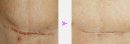 疤痕修复费用多少