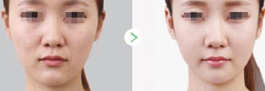 水光美容真的有效果吗