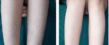 女孩子腿上汗毛太多怎么办好呢