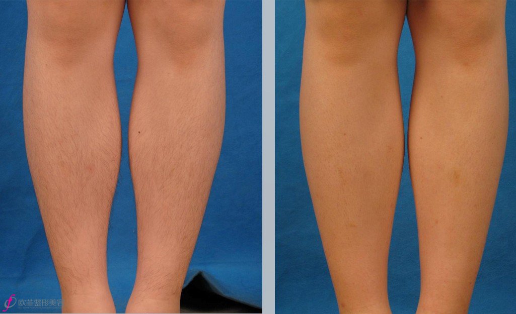 上海小腿脱毛的方法