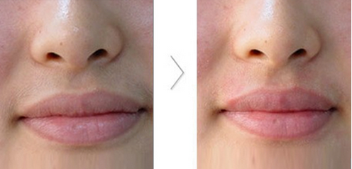 激光祛除唇毛有副作用吗