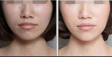 上海激光脱唇毛几次能脱彻底
