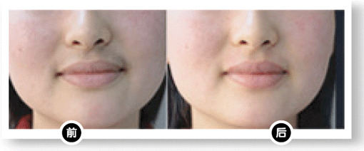 上海嘴巴上汗毛重怎么办