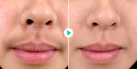 激光脱唇毛需要进行几次