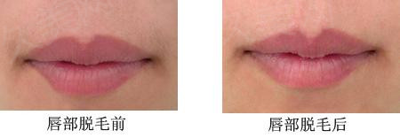 激光脱唇毛的大体优势是什么
