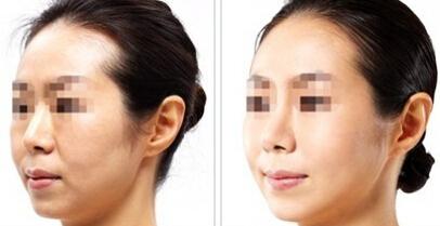 水光嫩肤效果好不好