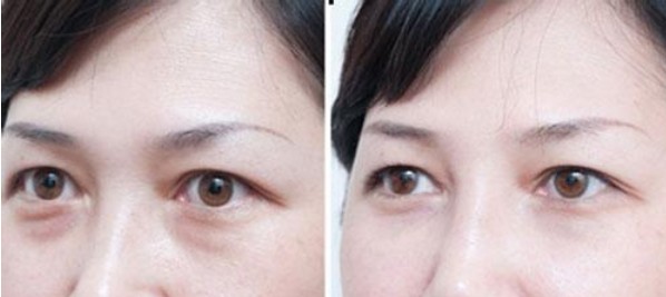 眼部吸脂该注意些什么