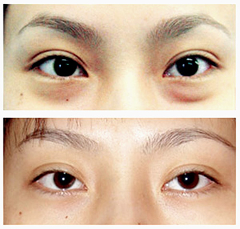 做眼部吸脂的优势是什么